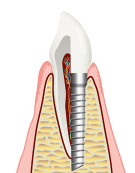 Dentalimplantologie